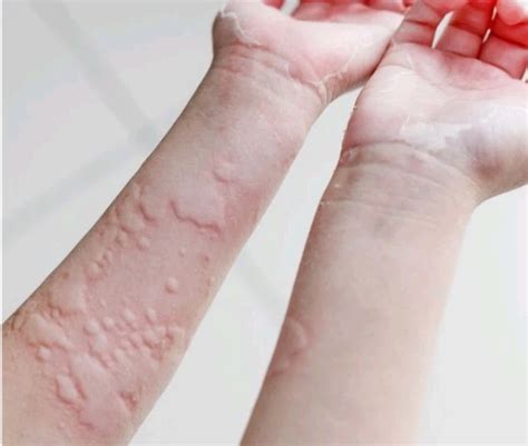 Gatal Alergi: Penyebab, Gejala, Dan Cara Mengatasinya