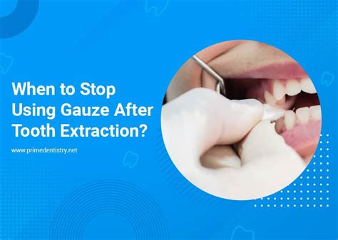 gauze after tooth extraction