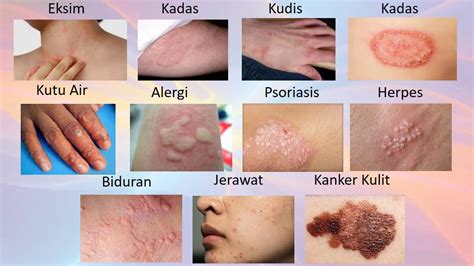 gejala infeksi pada kulit