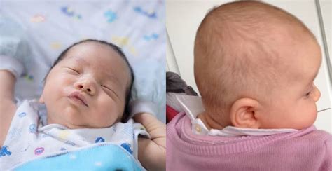 gejala kepala peyang pada bayi