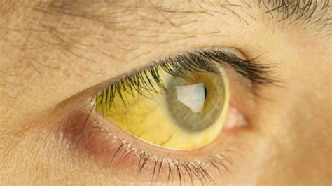 gejala mata kuning