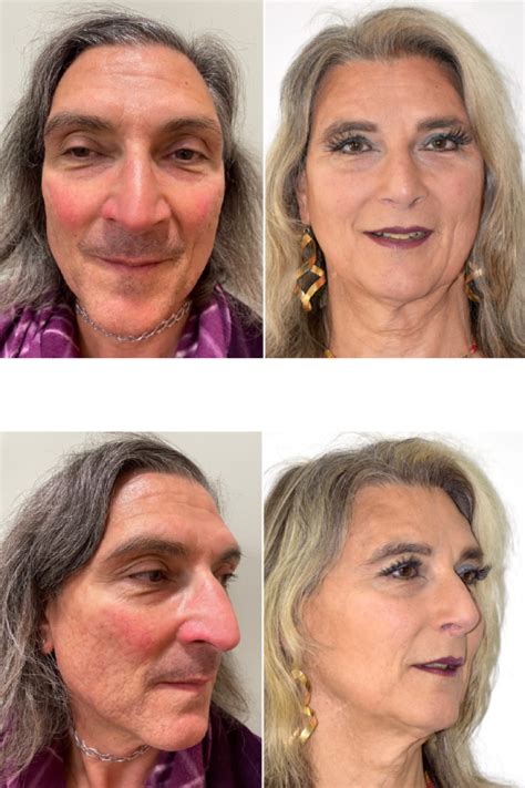 Understanding Gender Affirming Surgery: What You Need to Know About This Life-Changing Procedure