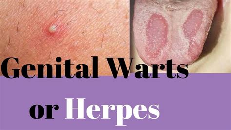 genital herpes type 1 or 2