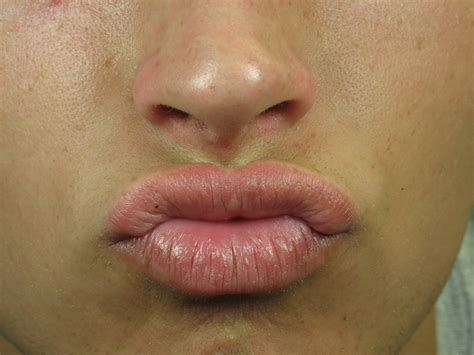 genital warts on lips