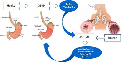 GERD and Asthma: Uncovering the Hidden Respiratory Connection