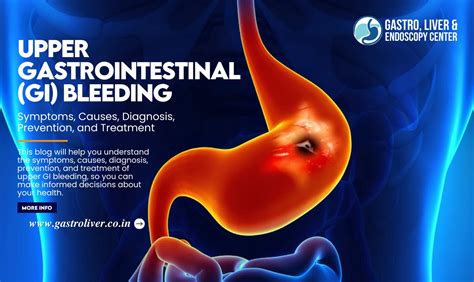 Gerd And Gi Bleeding