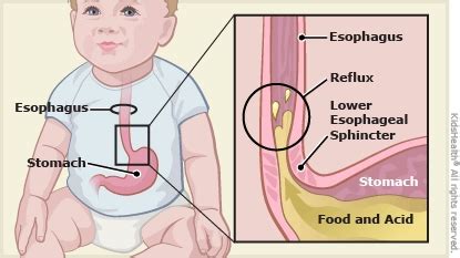 Understanding GERD in Babies: Causes, Symptoms, and Effective Treatments