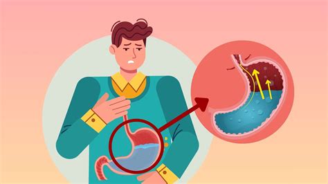 GERD Self Care: Effective Ways to Manage Symptoms Naturally