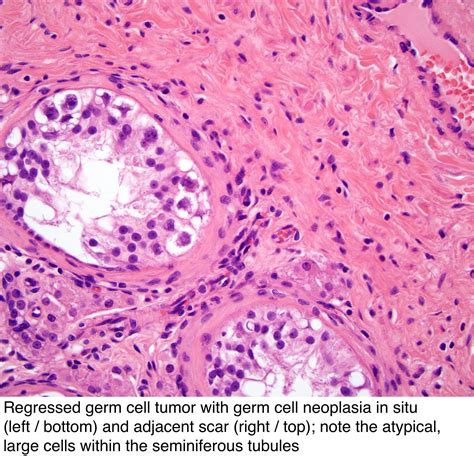 germ cell neoplasm