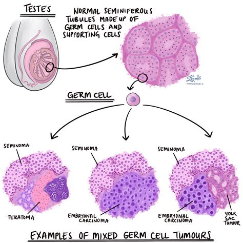 germ cell tumor example