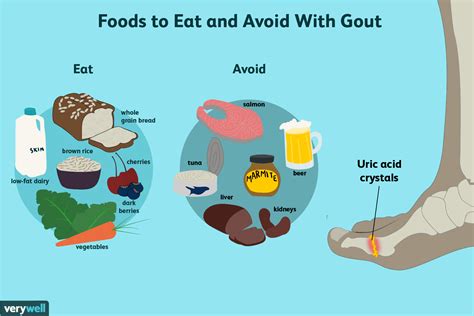 get gout diet