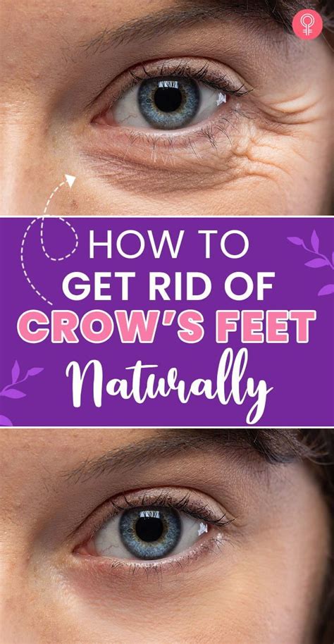 get rid of crows feet naturally