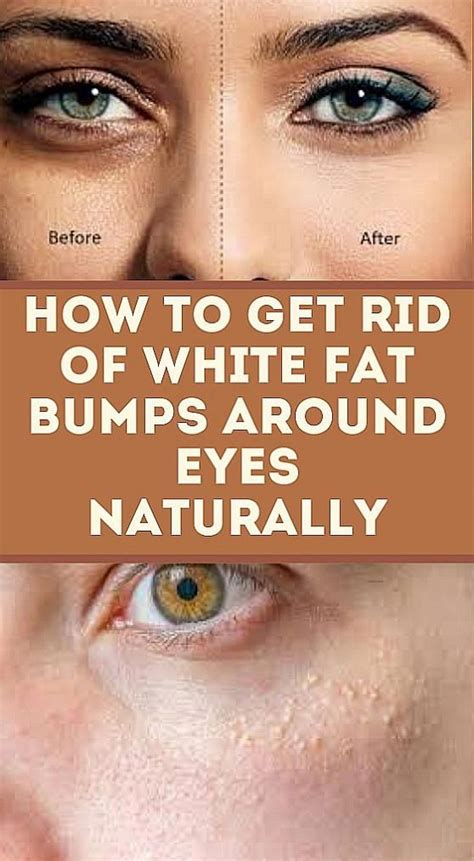 get rid of white fat