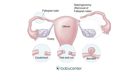 Getting Tubes Tied Young