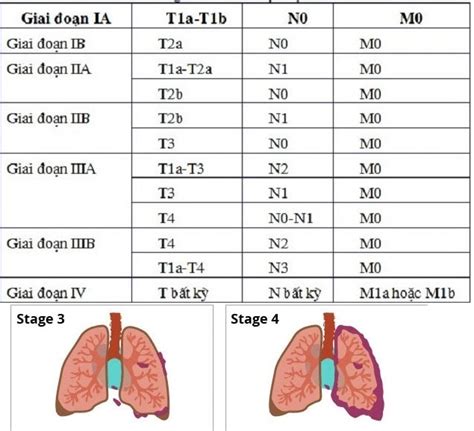 giai đoạn ung thư phổi