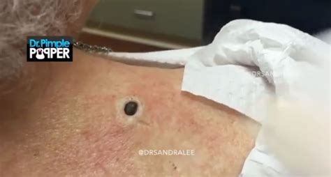 giant back blackhead