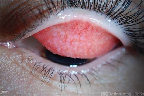 Understanding Giant Papillary Conjunctivitis: Causes and Treatment Options