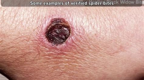 Giant Spider Bite