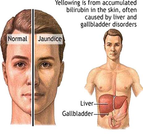 gilbert's disease and alcohol