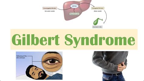 gilbert syndrome nhs
