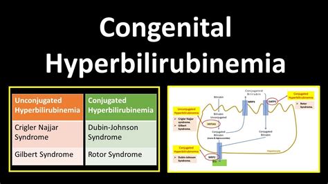 gilbert syndrome vs crigler-najjar