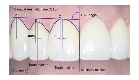 Gingival zenith point in dentistry News Dentagama