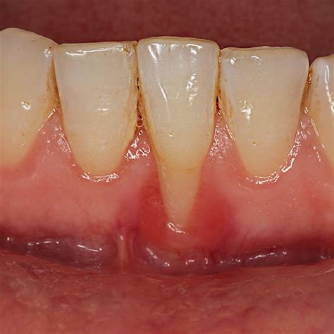 Gingival Retraction Recession