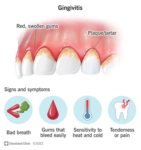 Gingivitis On One Tooth