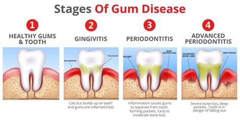 gingivitis vs periodontal disease