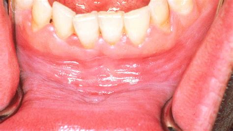 Gingivitis White Spots