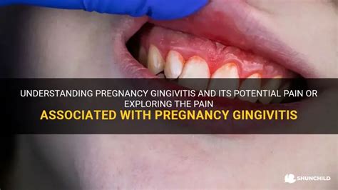 Gingivitis Zwanger
