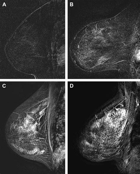 Glandular Enhancement