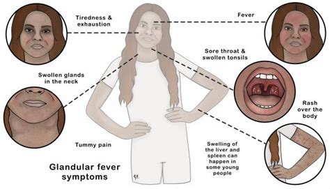 Glandular Fever Vitamins