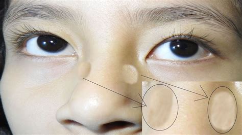 Glasses Mark On Side Of Head