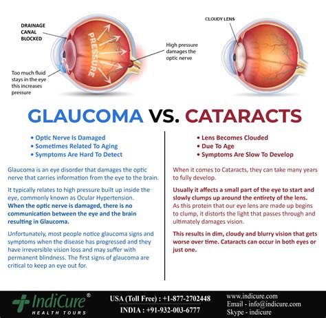 glaucoma vs cataracts differences