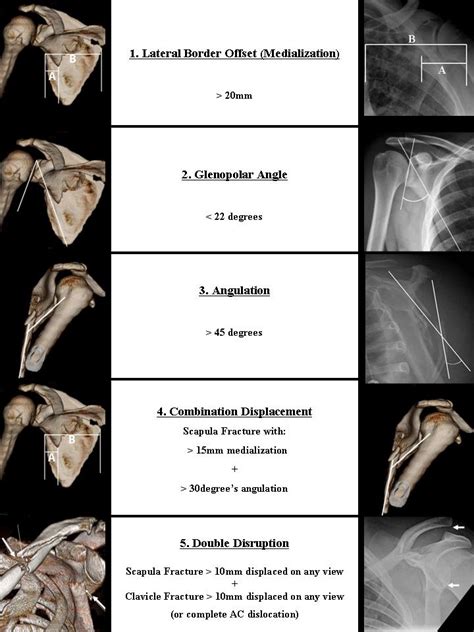 glenoid avulsion fracture icd 10