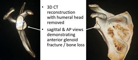 glenoid fracture icd 10