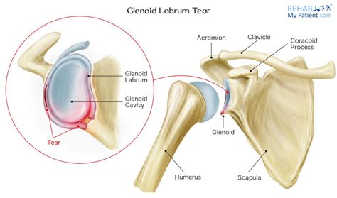 Glenoid Labrum Tear Shoulder