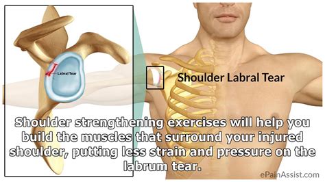 glenoid labrum tear surgery recovery time