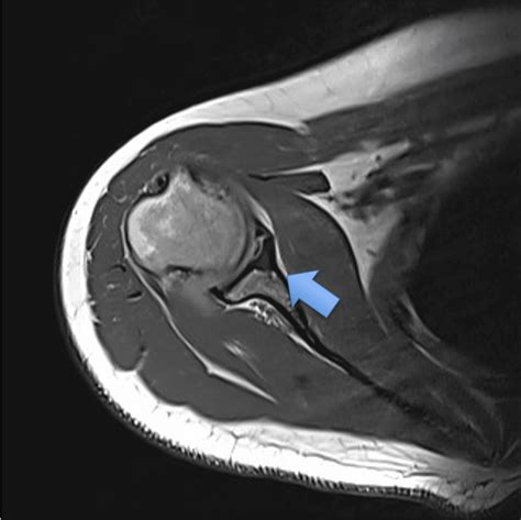 glenoidal cyst