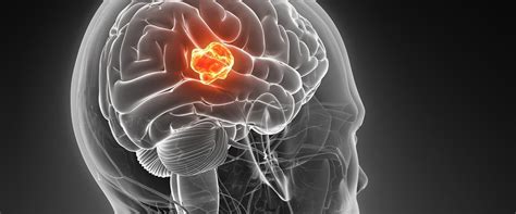glioblastoma brain tumor causes