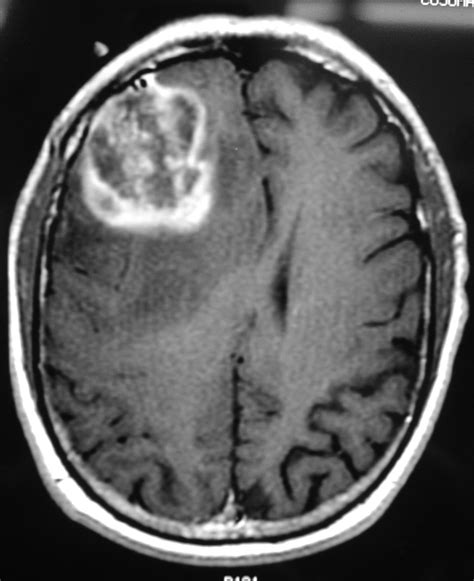 glioblastoma brain tumor frontal lobe