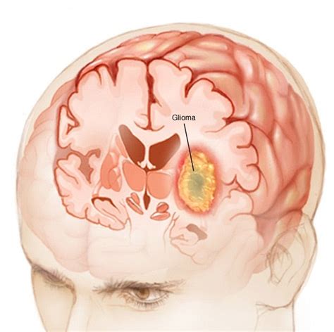 glioblastoma brain tumors stage 4