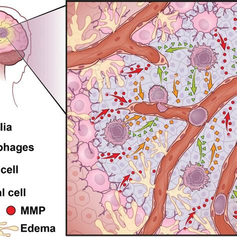 glioblastoma cerebral edema