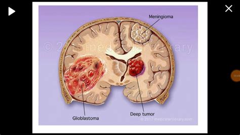 glioblastoma di grado 4