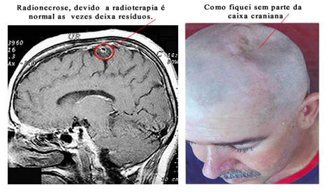 glioblastoma grau 4 casos de cura