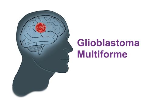 glioblastoma multiforme definition