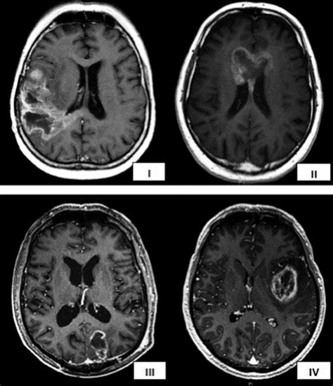 glioblastoma prognosis after recurrence