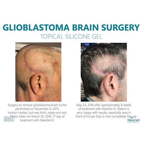 glioblastoma progression after surgery