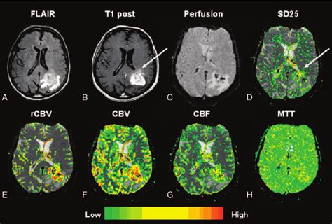 glioblastoma who grade 4